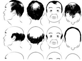 在南陽，選擇種植頭發(fā)價格怎么說？