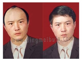怎樣治療脫發(fā)？男士治療脫發(fā)小秘方